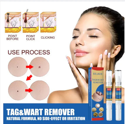 Sredstvo za Uklanjanje Bradavica i Mladeža (1+1 GRATIS!)