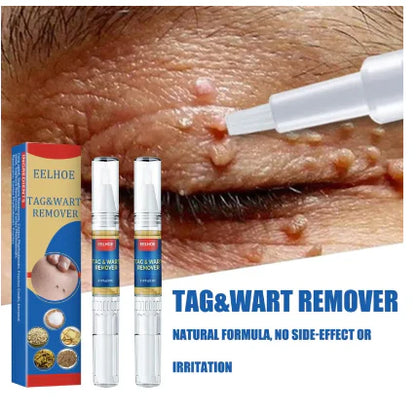 Sredstvo za Uklanjanje Bradavica i Mladeža (1+1 GRATIS!)