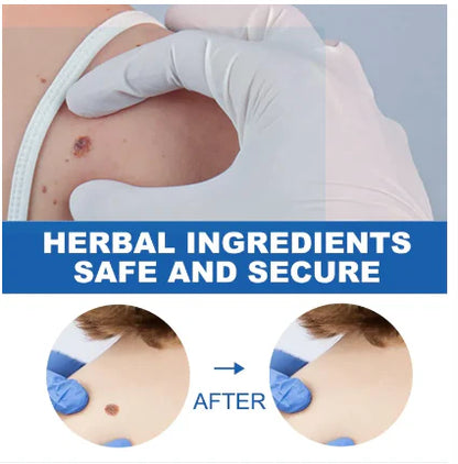 Sredstvo za Uklanjanje Bradavica i Mladeža (1+1 GRATIS!)